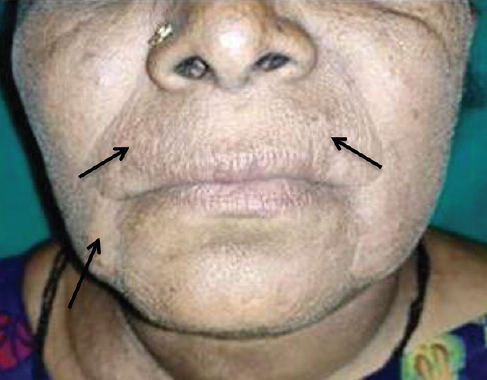 Post-treatment follow up at the end of third week (arrows).